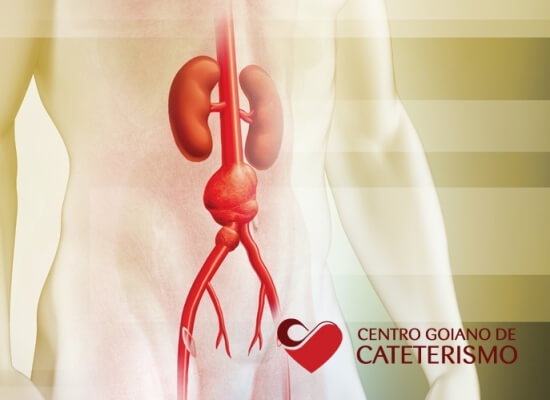 Aneurisma de Aorta Abdominal