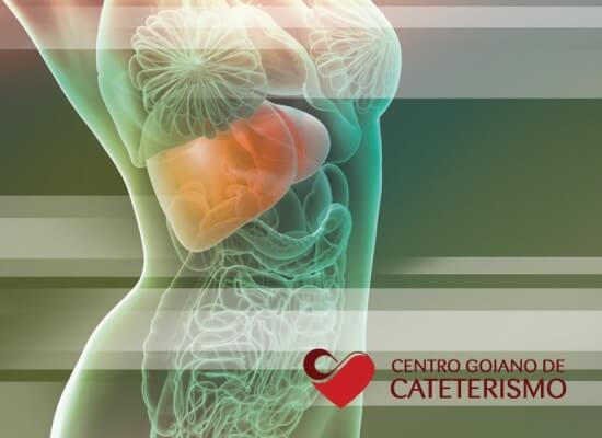 Doença hepática crônica: entenda a embolização de baço