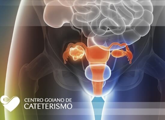 Miomas Uterinos – Tratamento de miomas com a preservação do útero