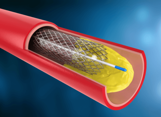Qual a diferença entre cateterismo e angioplastia?