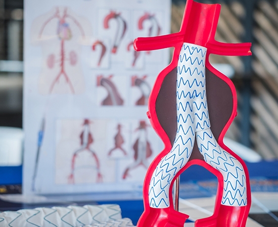 Aneurisma de Aorta Abdominal